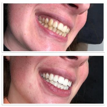 Luxsmile Zobni Beljenje Zob Komplet 35%HP Zob Beljenje Komplet Za 2 osebi, Primeren Za Klinike In Zdravilišča